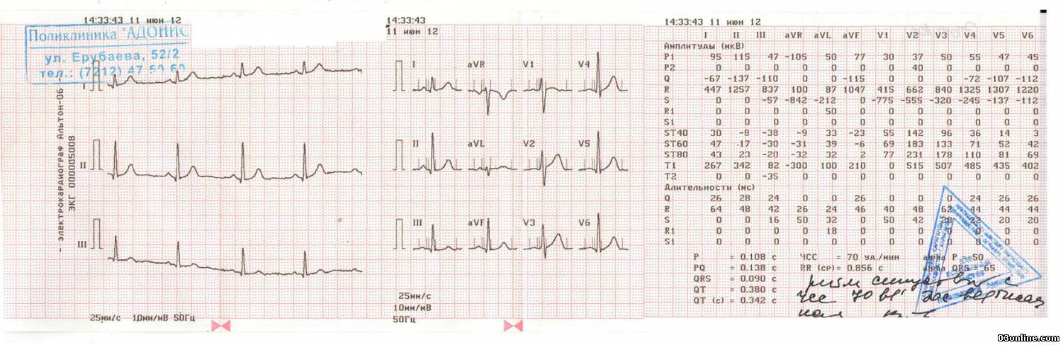 Расшифровка ЭКГ для чайников с примерами - E-Cardio