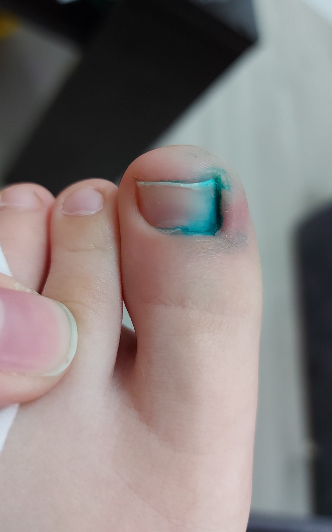 Почему Краснеют Ногти Пальцев На Ногах Фото