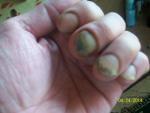 Грибок ногтей лечение фото 1