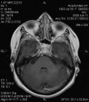 Опухоль в лобной доле головного мозга фото 5