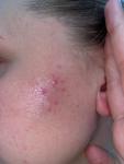 Сыпь на одной стороне лица около 4 месяцев фото 3