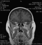 Опухоль в лобной доле головного мозга фото 3