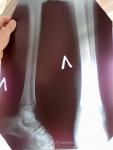 Перелом лодыжки латеральной реабилитация фото 1