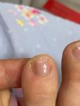 Продольная темная полоса на ногте-подногтевая меланома? фото 1