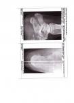 Спицевое вытяжение после перелома пяточной кости со смещением фото 2