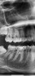 Болит зуб после удаления нервов фото 2