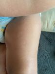 Появление мелких прыщиков у ребёнка на ногах, руках и животе фото 2
