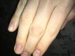 Огрубевшая кожа на сгибе пальца и трещинки фото 1