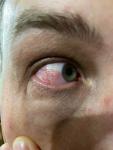 Покраснение глаза с легким болевым синдромом фото 2