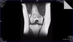 Непонятные результаты МРТ коленного сустава фото 5