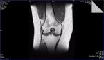 Непонятные результаты МРТ коленного сустава фото 1