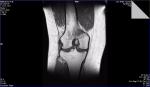 Непонятные результаты МРТ коленного сустава фото 2