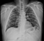 Двусторонняя пневмония, рентген фото 1