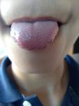Воспаление языка, пупырышки на кончике языка фото 1