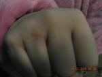 Уплотнение кожи на тыльной стороне рук фото 2