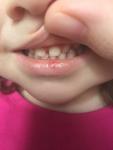 Щель между зубами у ребенка 1 год (пройдет или нужно лечить? фото 1