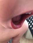 Воспалённое Образование на губе у ребёнка, когда трогаешь ребёнку больно фото 1