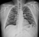 Двусторонняя пневмония, рентген фото 2
