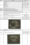 Фиброзно-железистый полип, киста левого яичника, замершая беременность фото 3