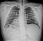 Двусторонняя пневмония, рентген фото 3
