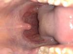 Состояние горло, хронический тонзиллит фото 1