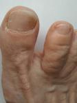 Грибок ногтя на ноге фото 1