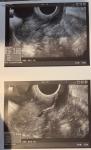 Короткая шейка после родов и рубцовая деформация фото 3