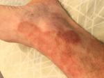 Повреждения на подъеме ног фото 1