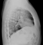 Двусторонняя пневмония, рентген фото 4