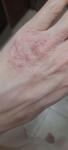 Мелкие, водянистые пузыри на коже рук, сильный зуд и раны фото 4