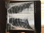 Пневмония или бронхит на рентгене фото 1
