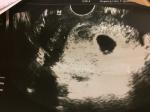 Миома при беременности фото 1