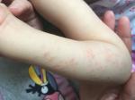 Аллергия у ребёнка 2,5 года фото 2