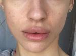 Периоральный дерматит, краснота вокруг носа, нос красный, сыпи нет фото 1
