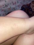 Сыпь на ножках у ребенка 1,5 года фото 3