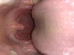Состояние горло, хронический тонзиллит фото 2