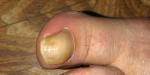 Изменение формы ногтя большого пальца ноги фото 2
