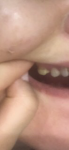 Зуб потемнел фото 1