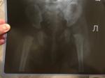 Дисплазия тазобедренных суставов у грудничка 3 месяца фото 1