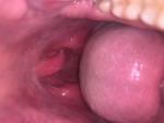 Синусит, воспалённое горло и неизвестное новообразование фото 3