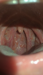 Боль в горле гранулёзный фарингит? фото 1