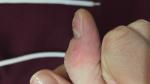 Деформация ногтей на больших пальцах фото 3
