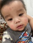 Покраснение и сыпь на щеках у ребёнка 10 месяца фото 3