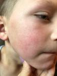 Сыпь у ребёнка на щеках и ушах фото 2