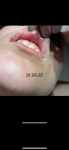 Воспаление слизистой щеки фото 1