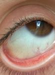 Пожелтение в белках глаза после линз фото 1