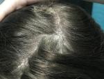 Псориаз волосистости части головы фото 5