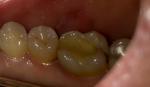 Ноющие боли зуба фото 3