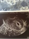 Нет эмбриона и СБ на 7 акушерской недели фото 1