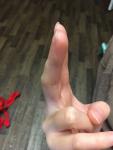Шишка у основания пальца на руке фото 2
